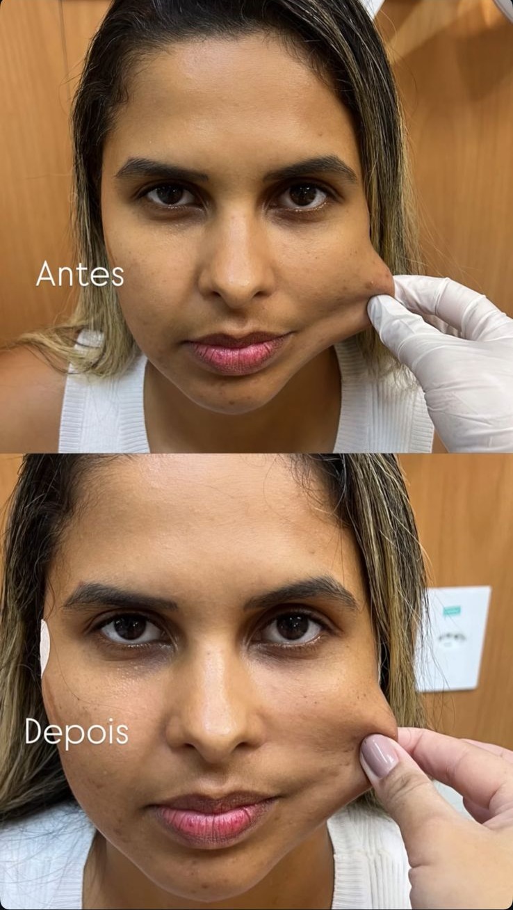Antes e depois de bioestimulador de colágeno, com a pele da face avaliada pelo toque