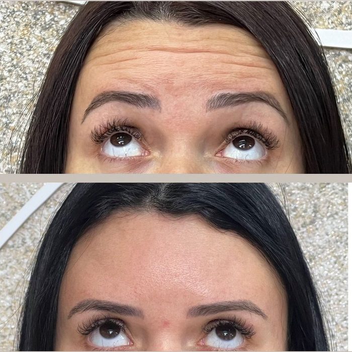 Antes e depois da região frontal após botox full face