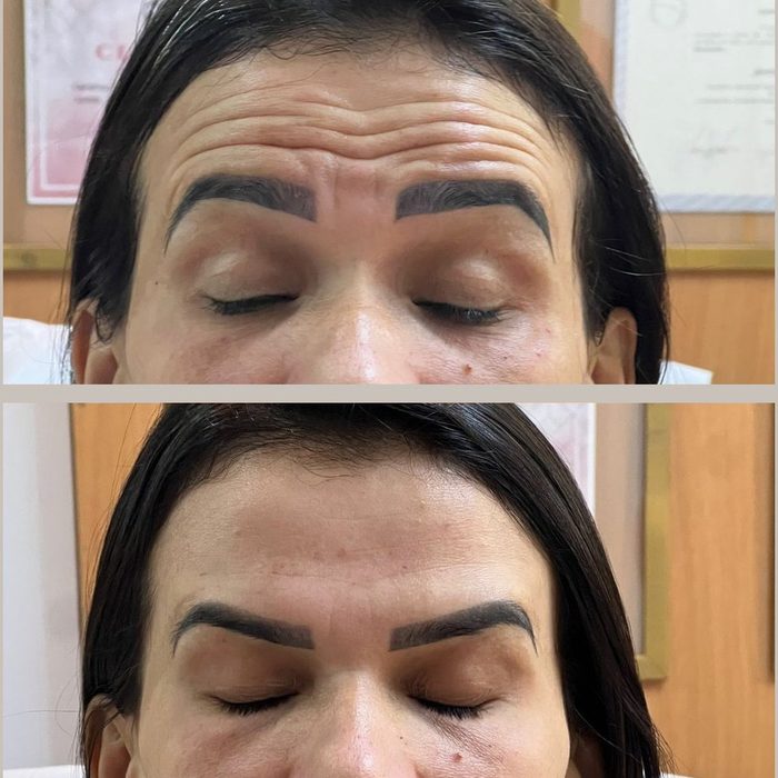 Antes e depois da região frontal de outra paciente após botox full face