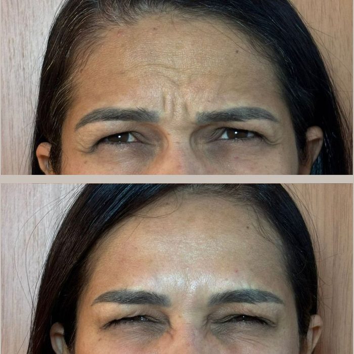 Antes e depois da glabela após botox full face