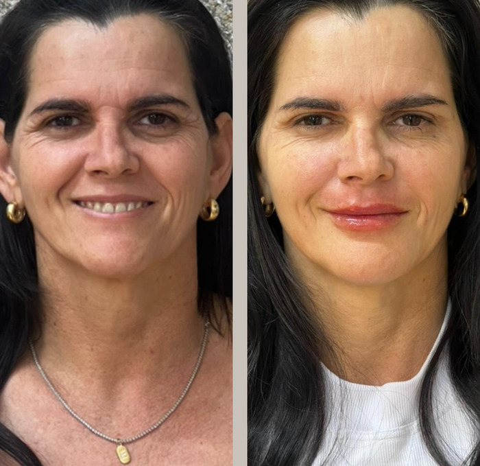 Antes e depois de harmonização facial, face completa