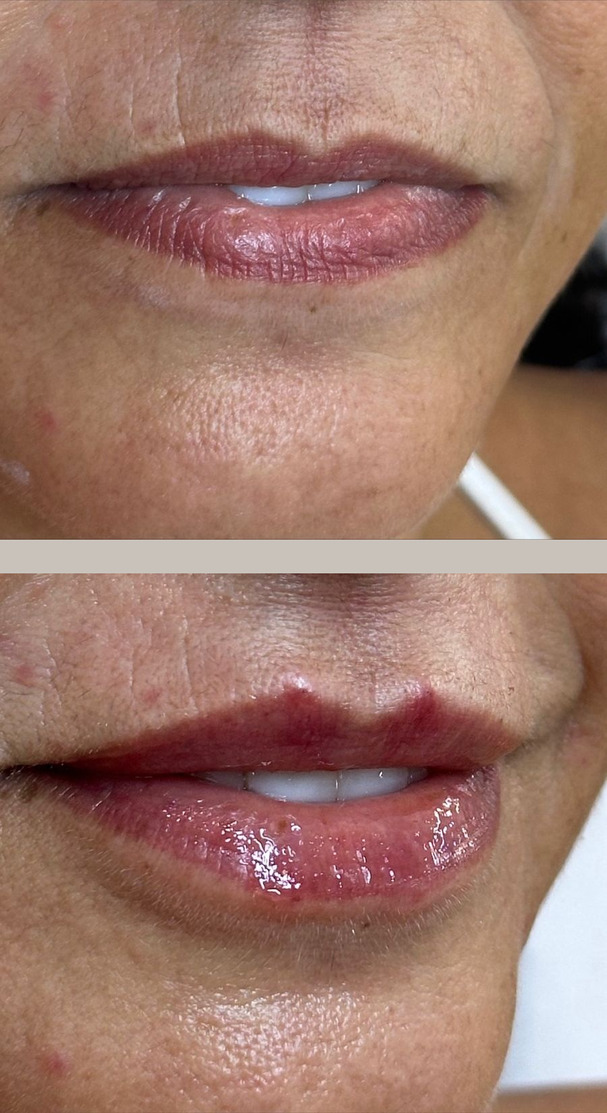 Antes e depois de preenchimento labial, vista frontal