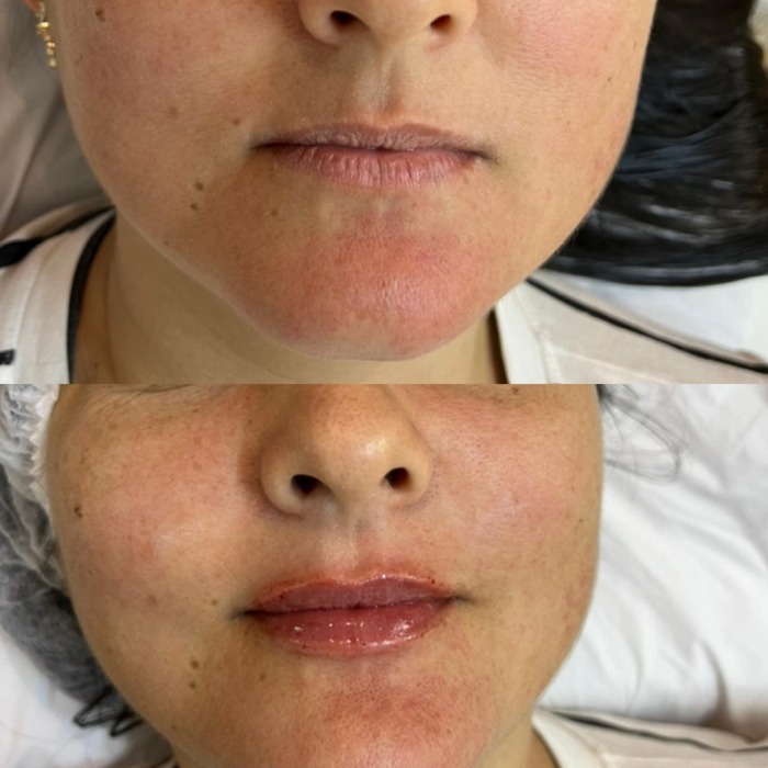 Antes e depois de preenchimento labial em outra paciente, vista frontal