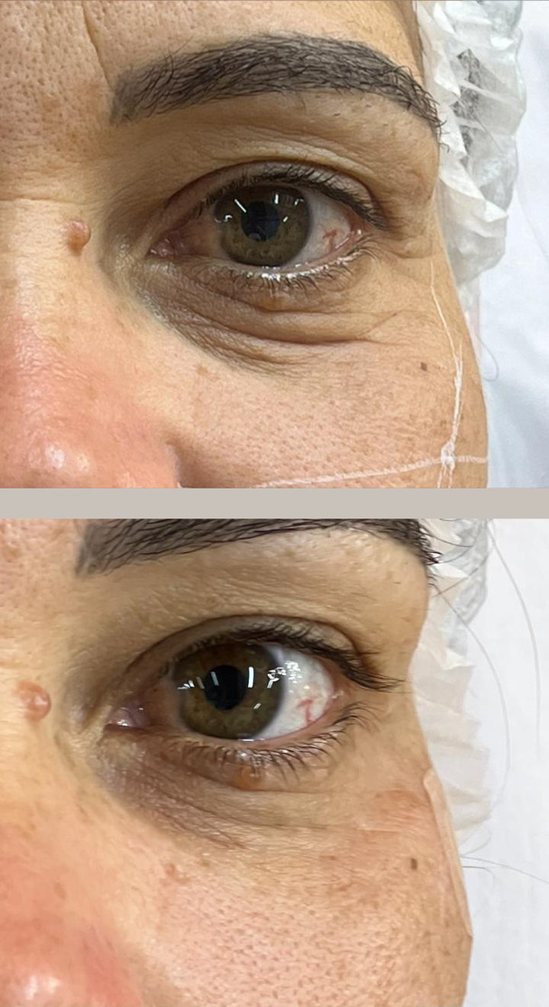 Antes e depois de preenchimento de olheiras