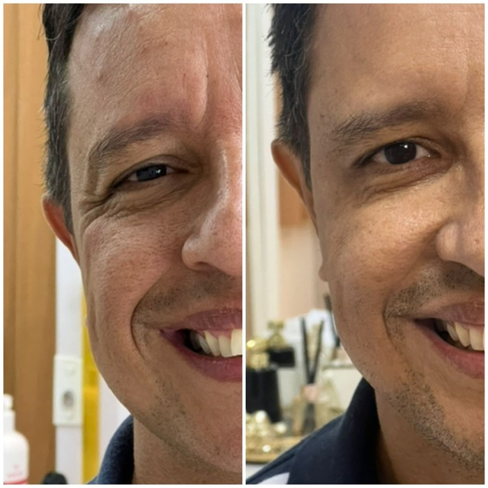 Antes e depois dos pés de galinha em paciente homem, sorrindo nas duas metades